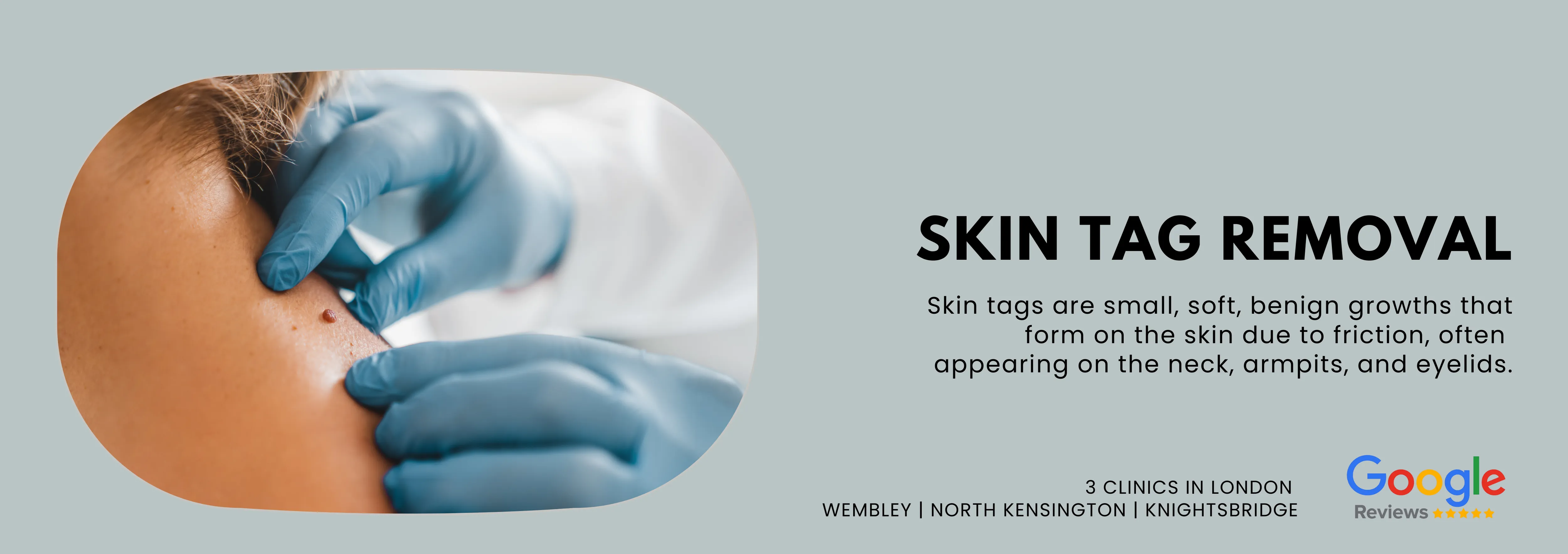 Skin Tag Removal