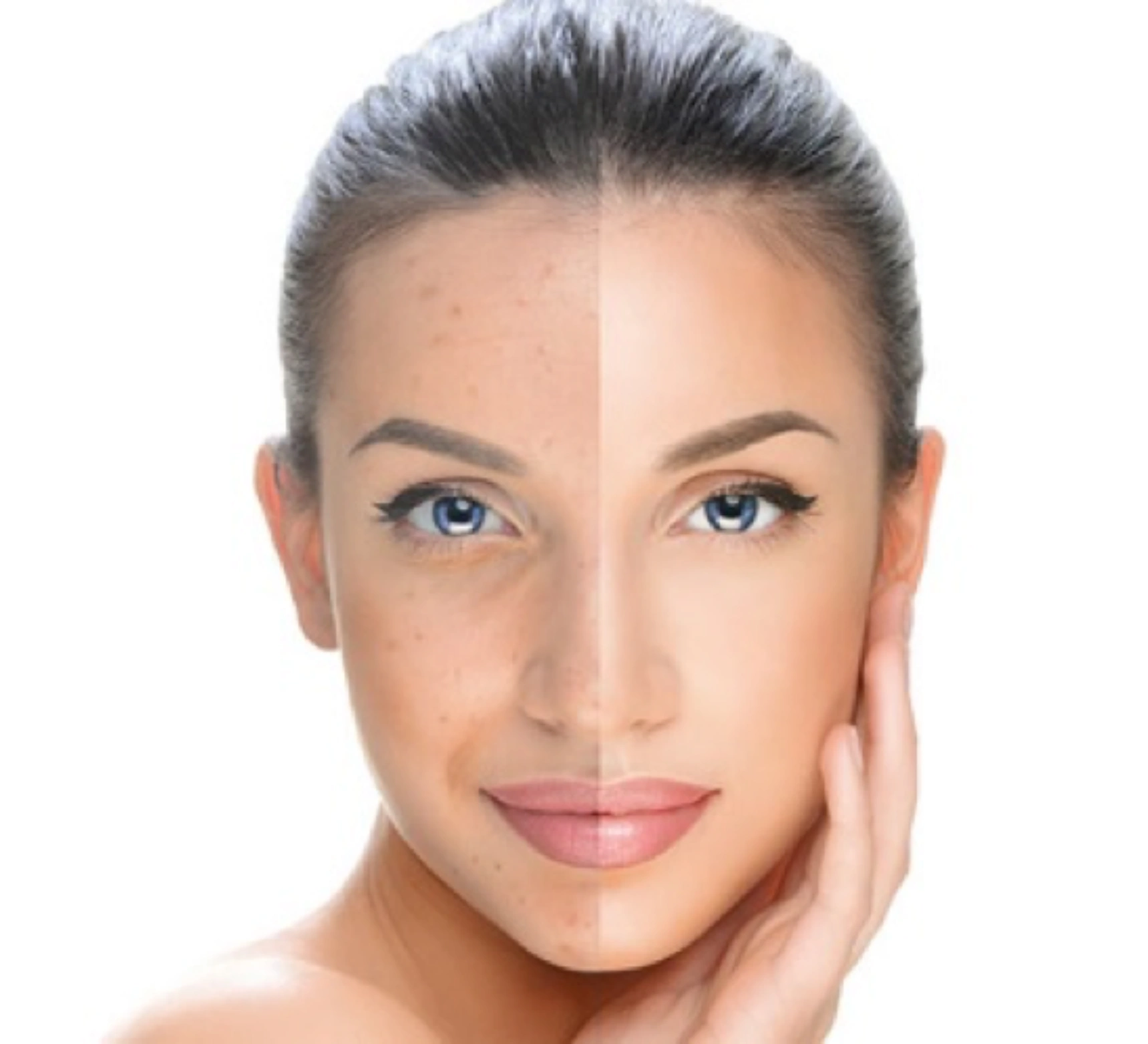 hyperpigmentation