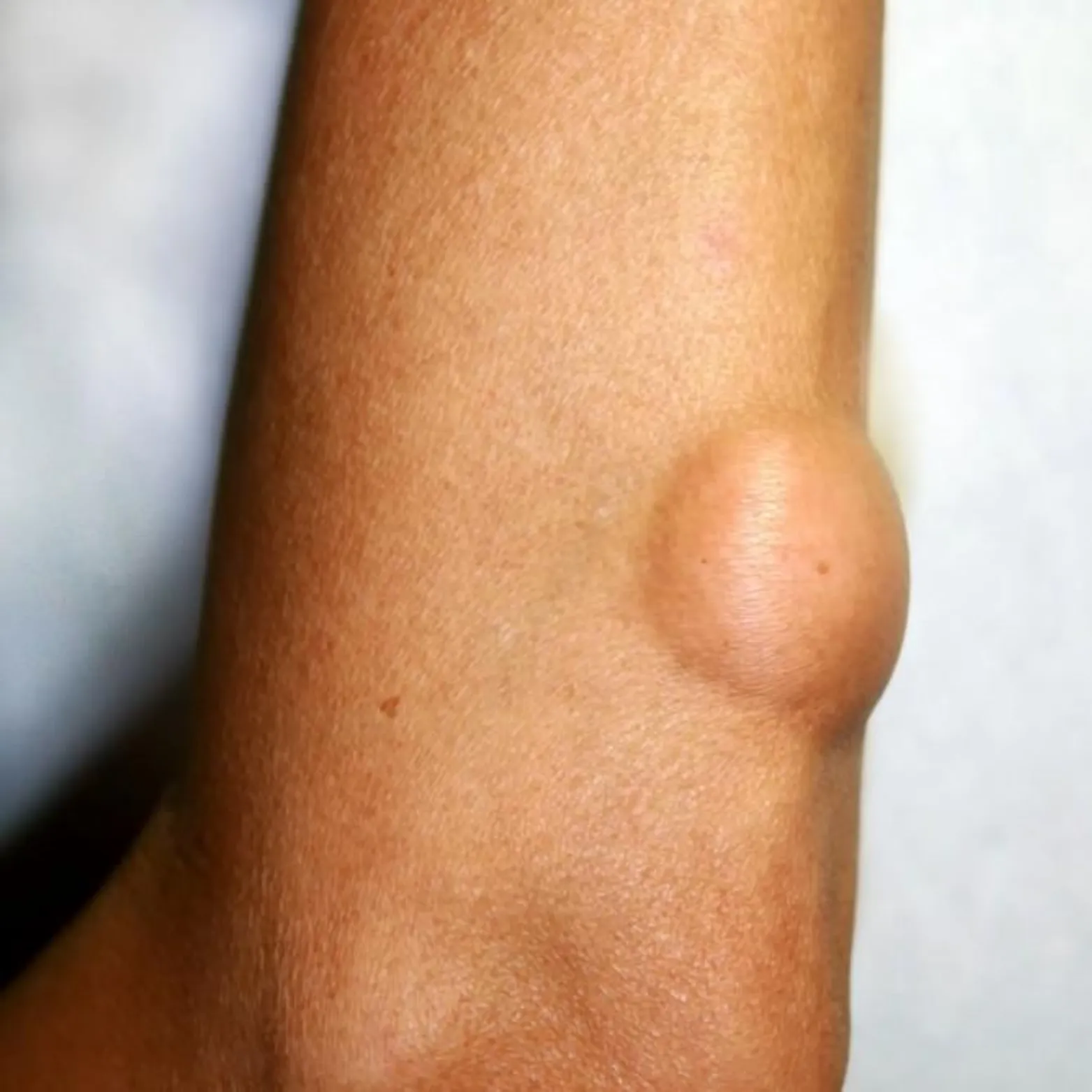 Lipoma Removal