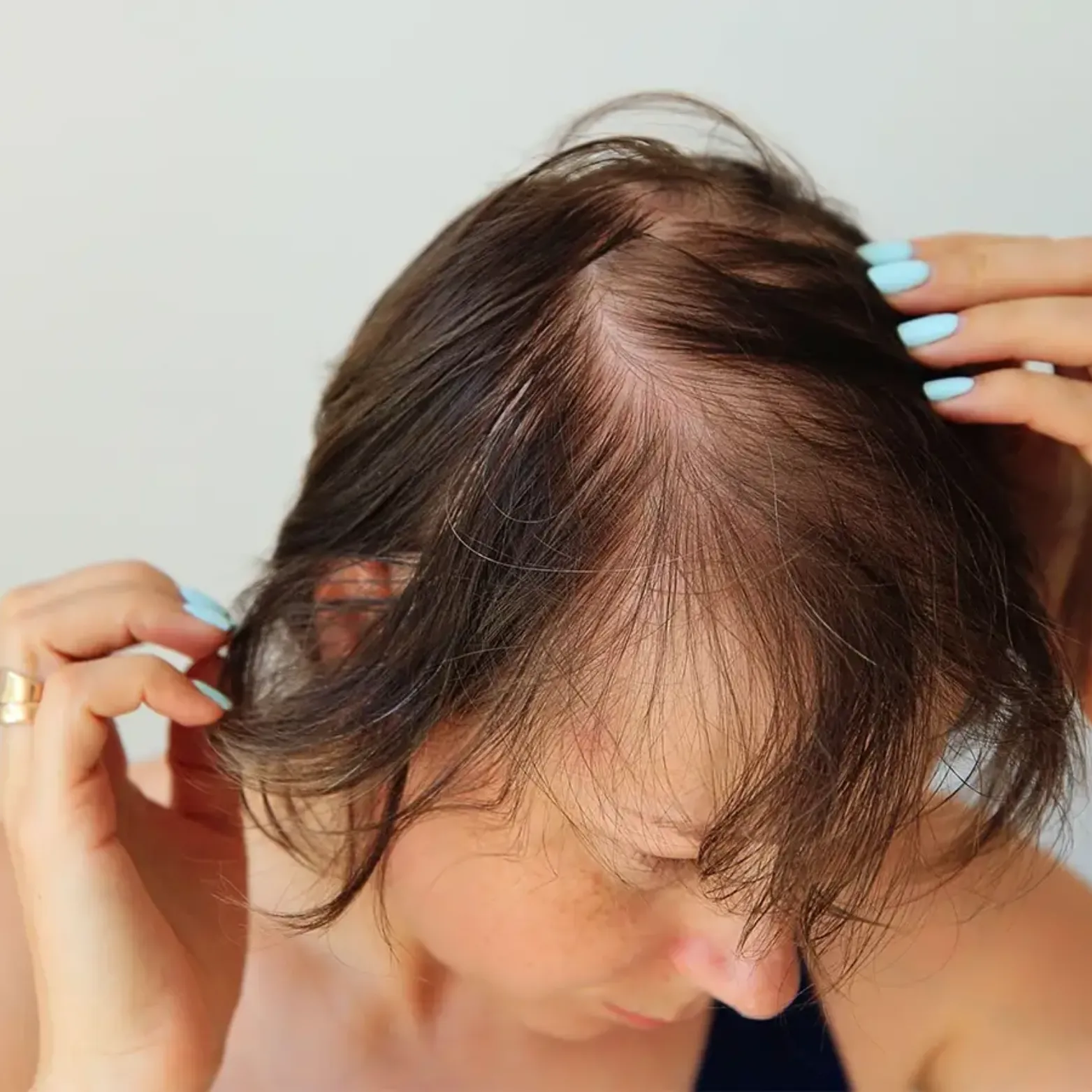 Exosomes Hair Loss and Scalp Stimulation Treatment