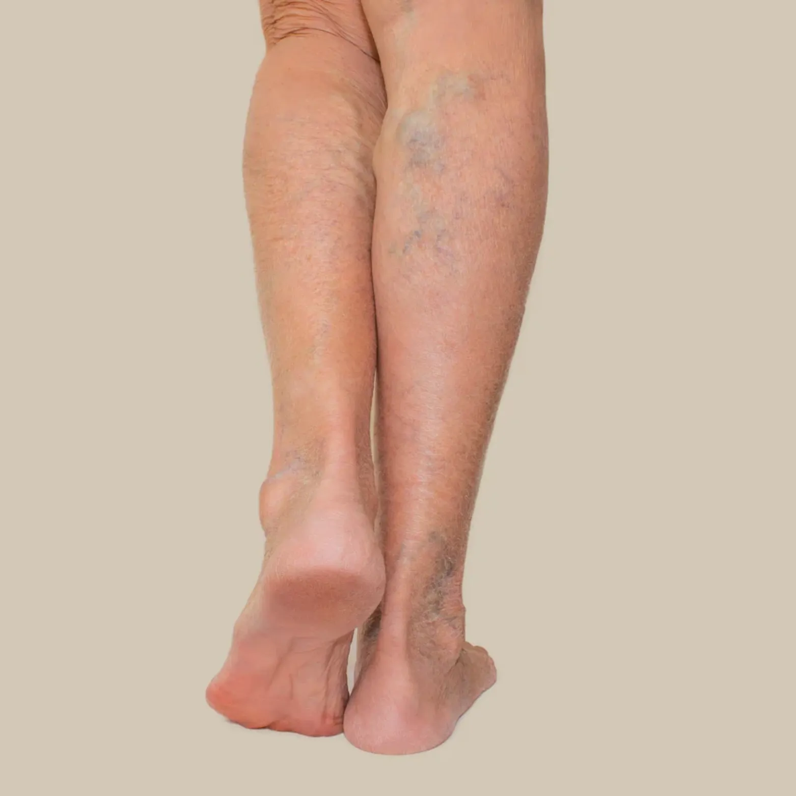 Leg Vein Removal