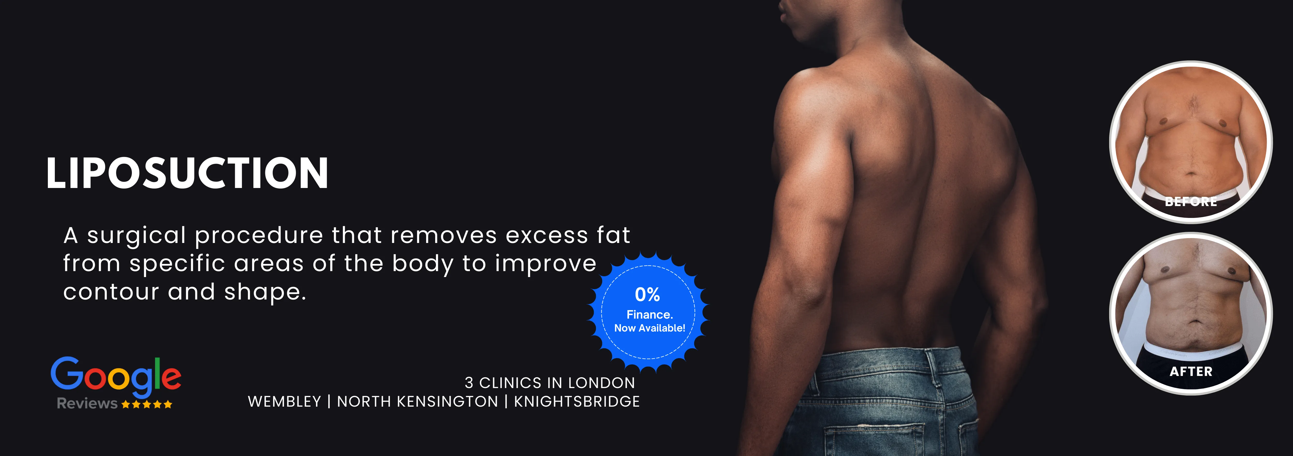 Liposuction