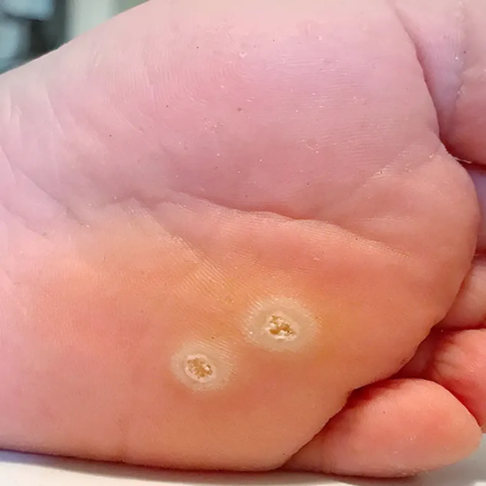 Verruca Removal