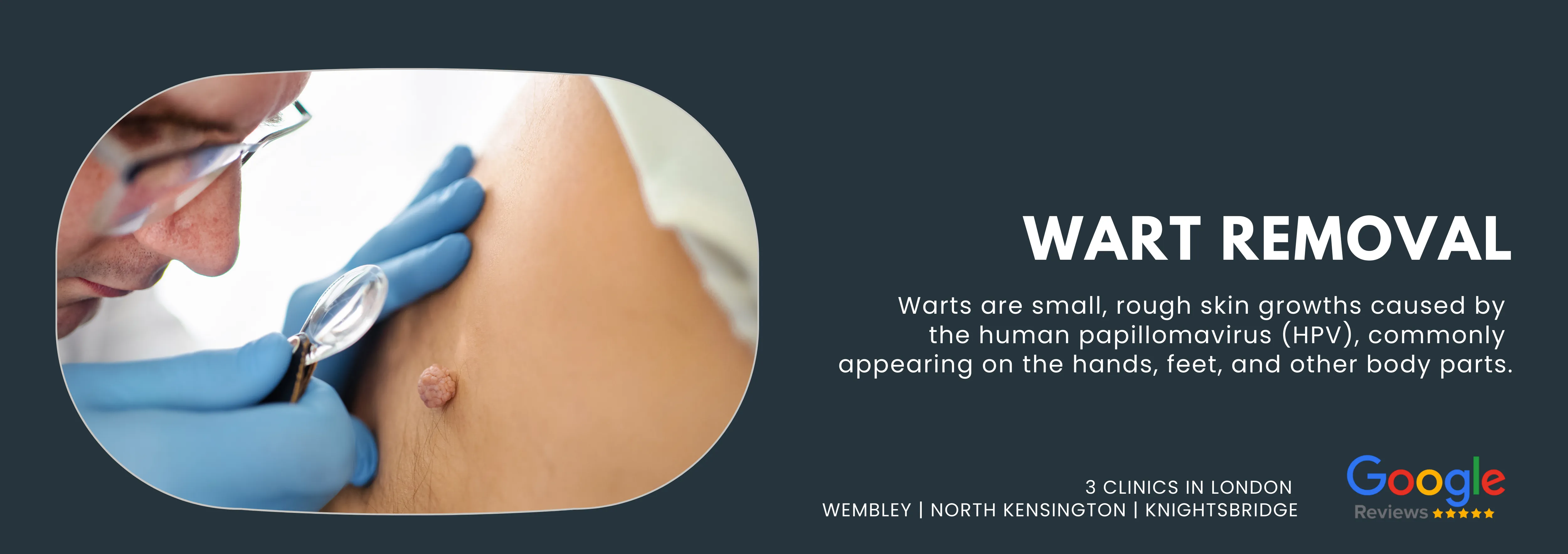 Wart Removal