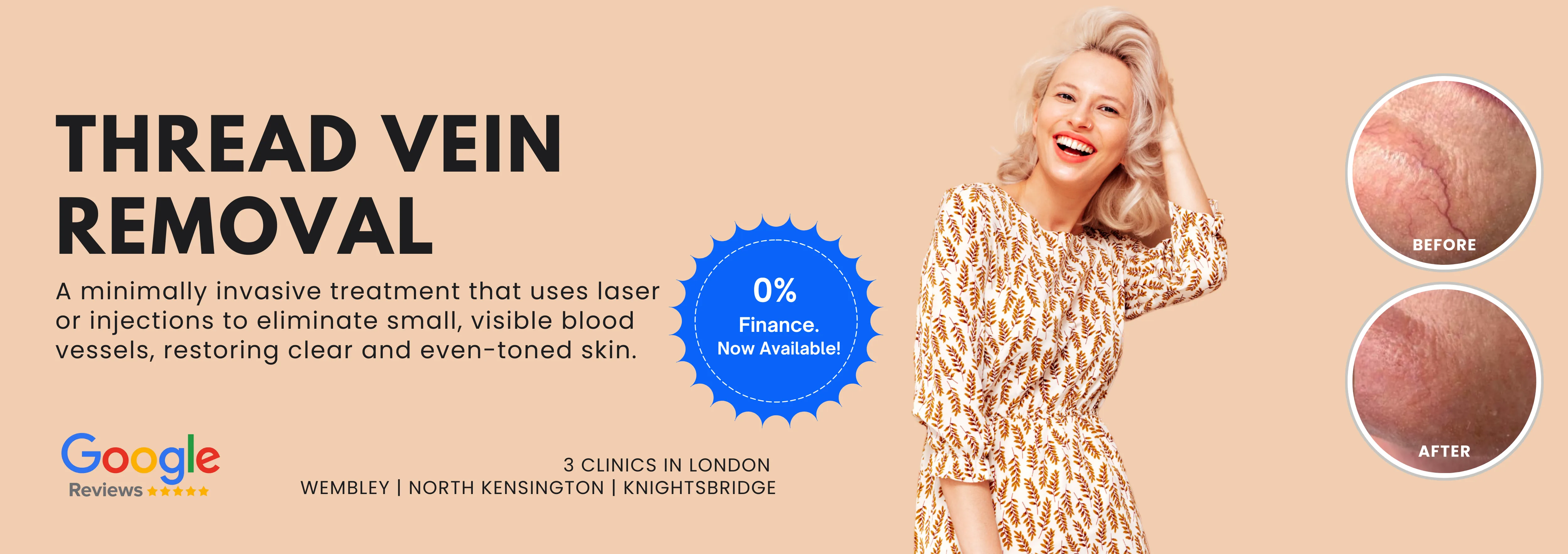 Thread Vein Removal