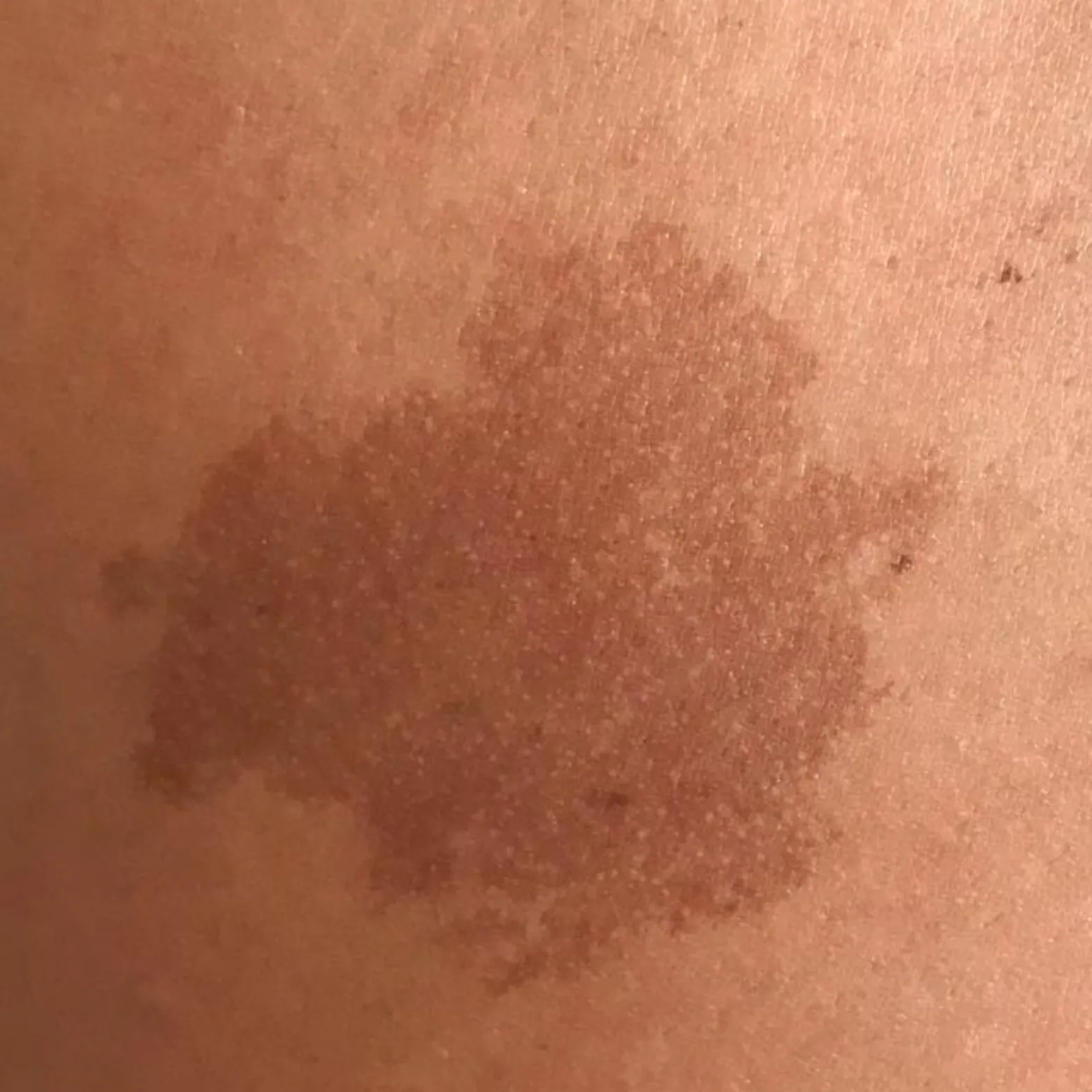 Birthmarks