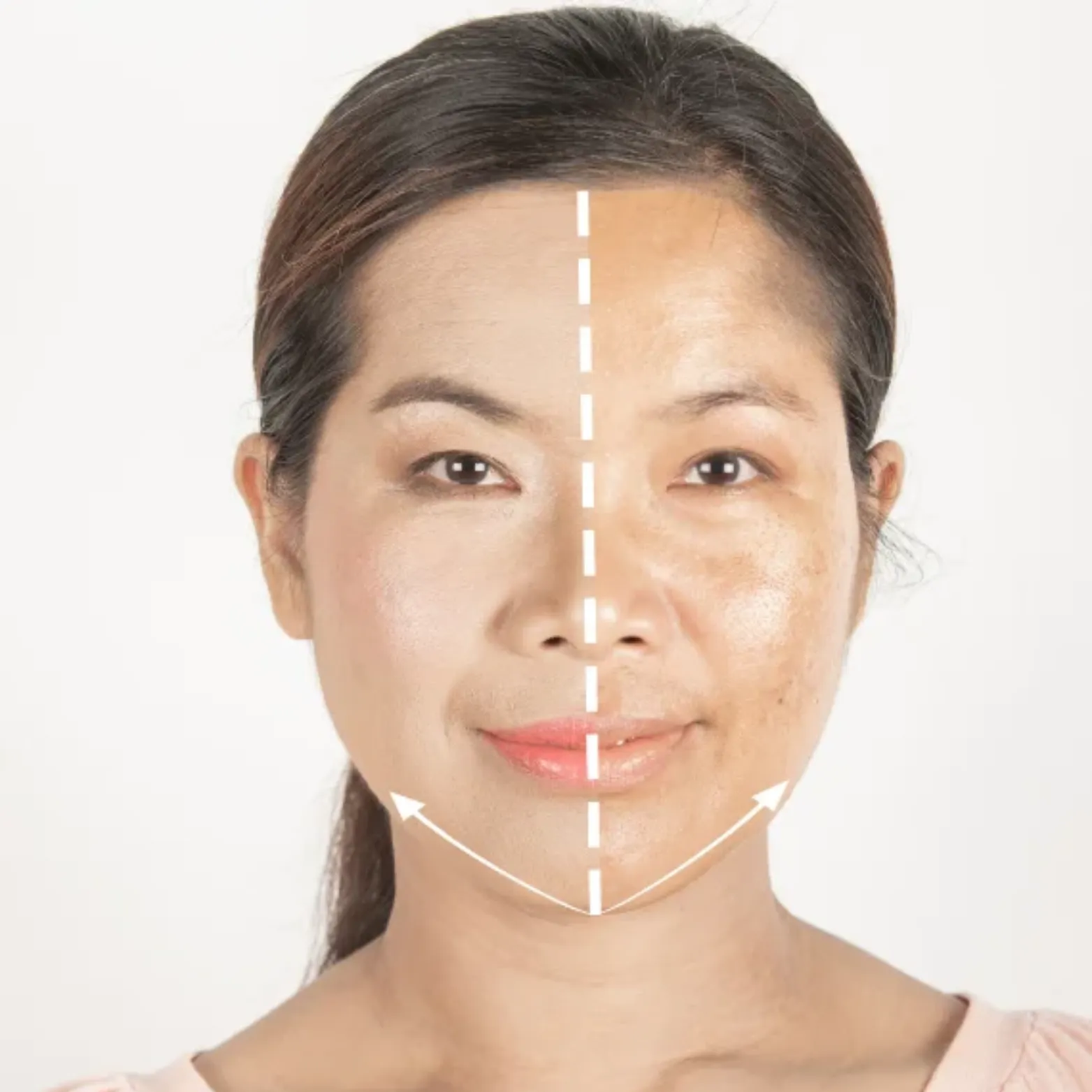 Freckle Removal