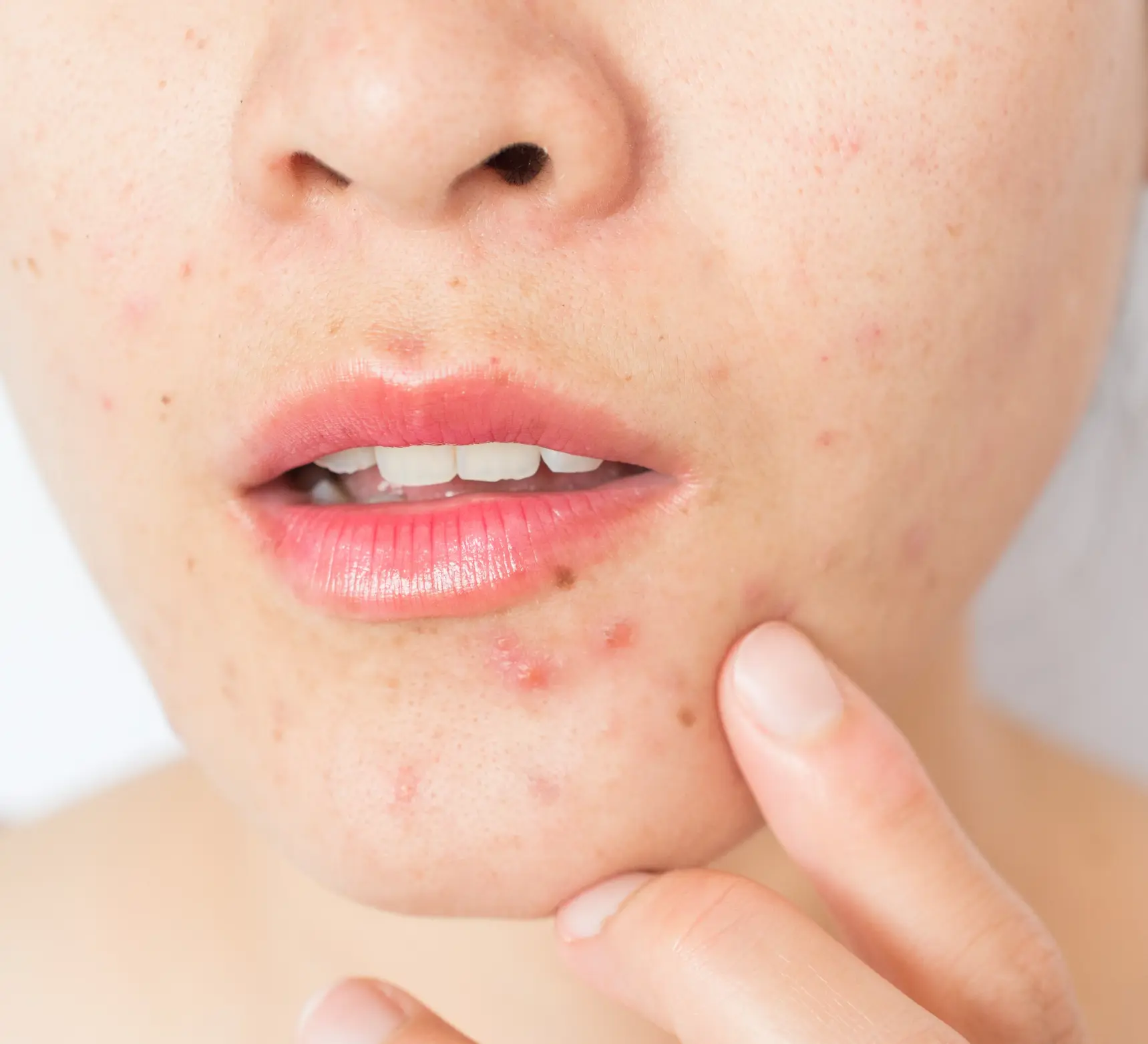 Ingrown Hair