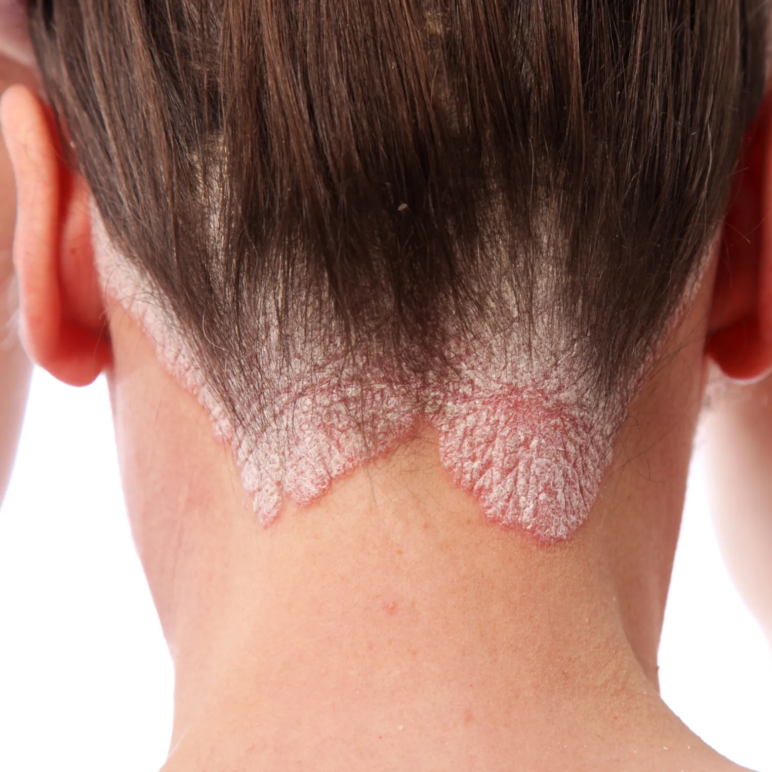 Psoriasis