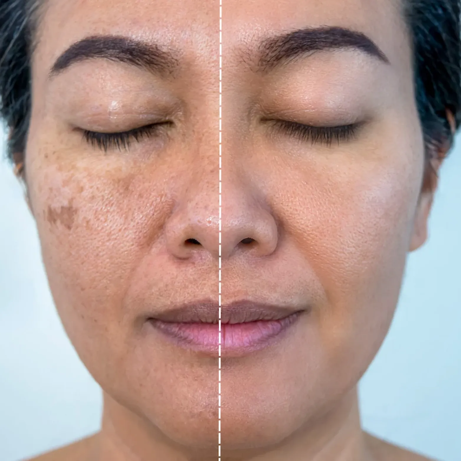 Melasma Treatment