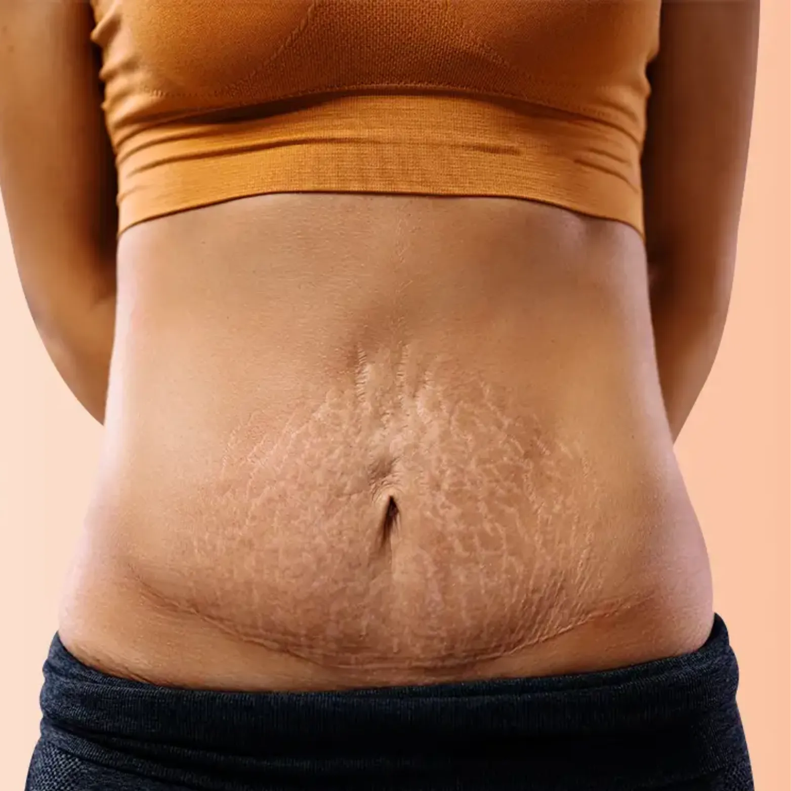 Stretch Mark Removal