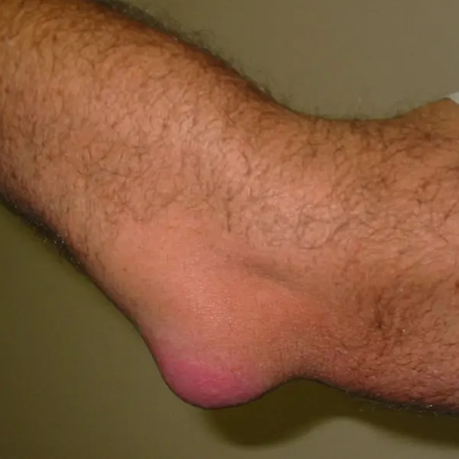Lipoma