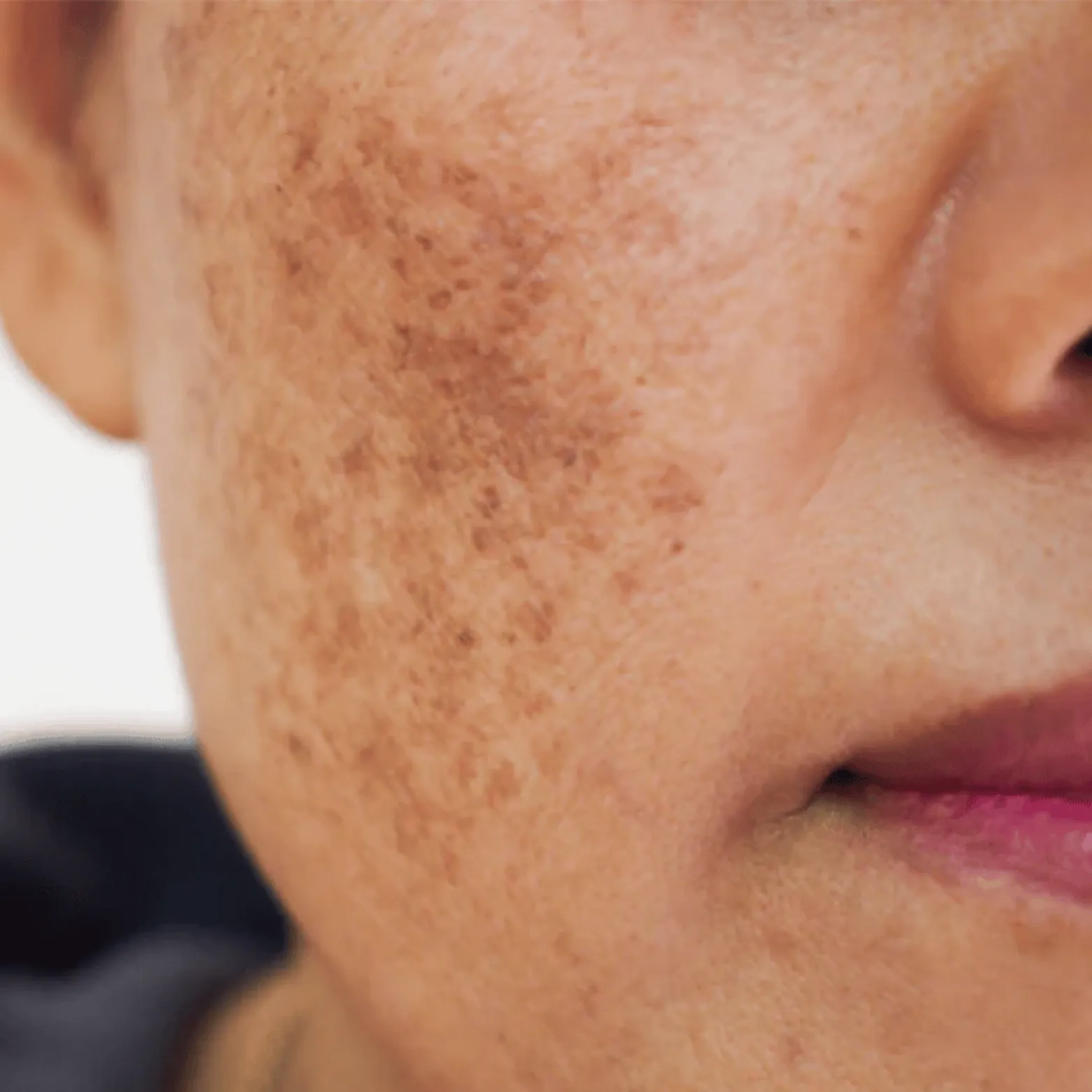Melasma