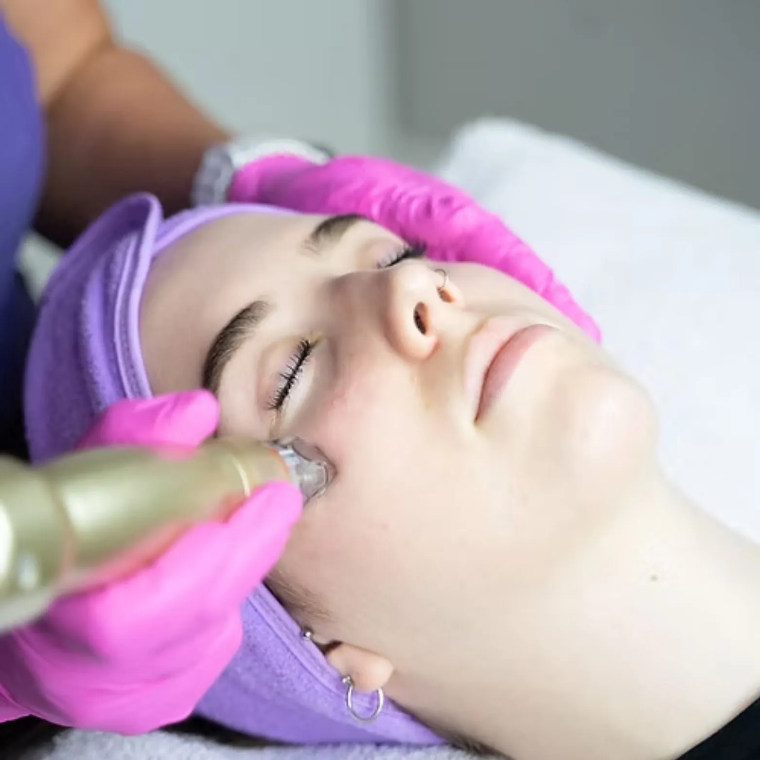 SylfirmX RF Microneedling Treatment
