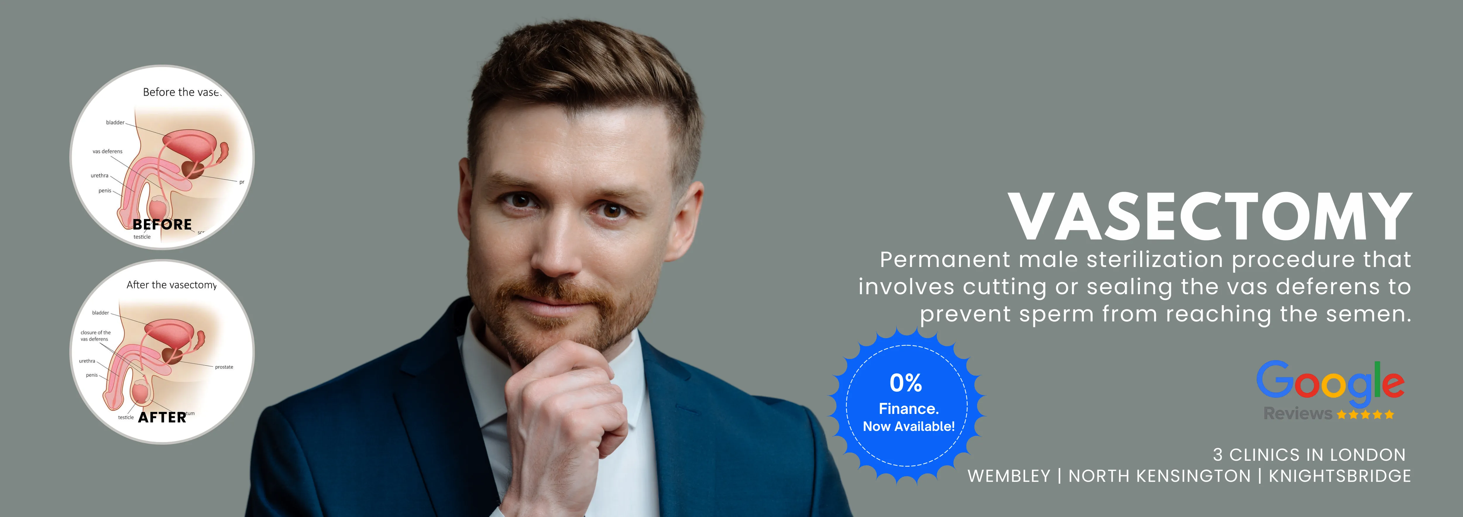 Vasectomy