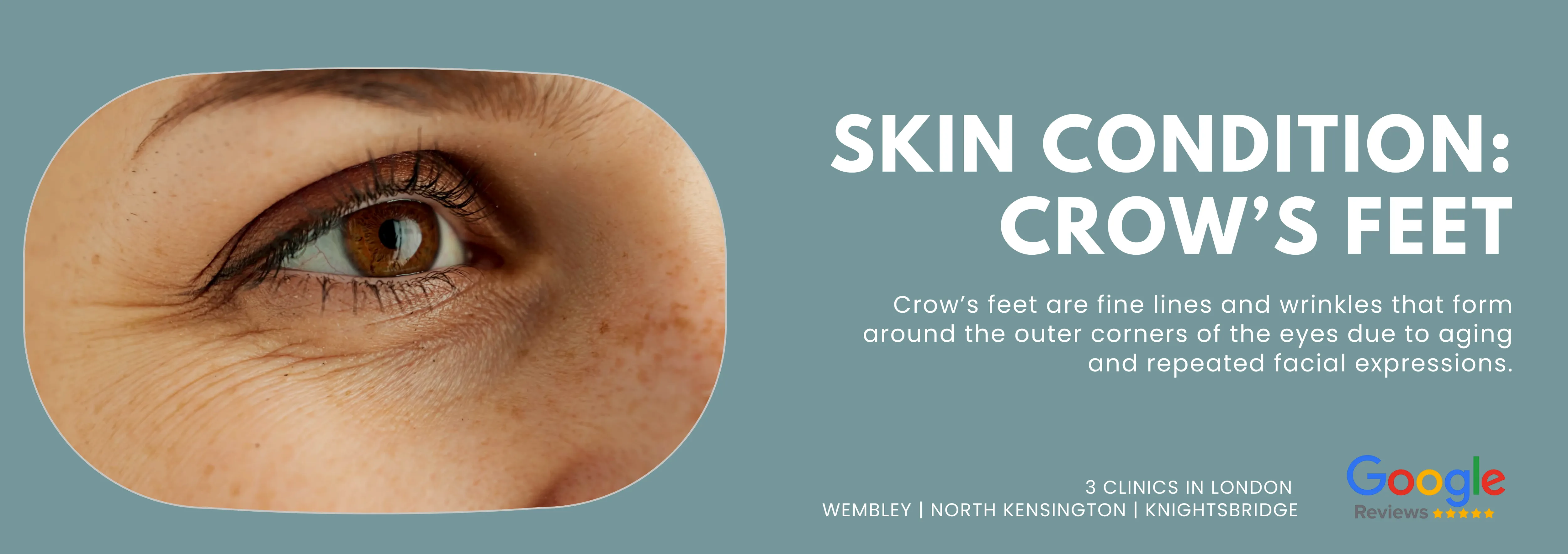 Crow’s Feet
