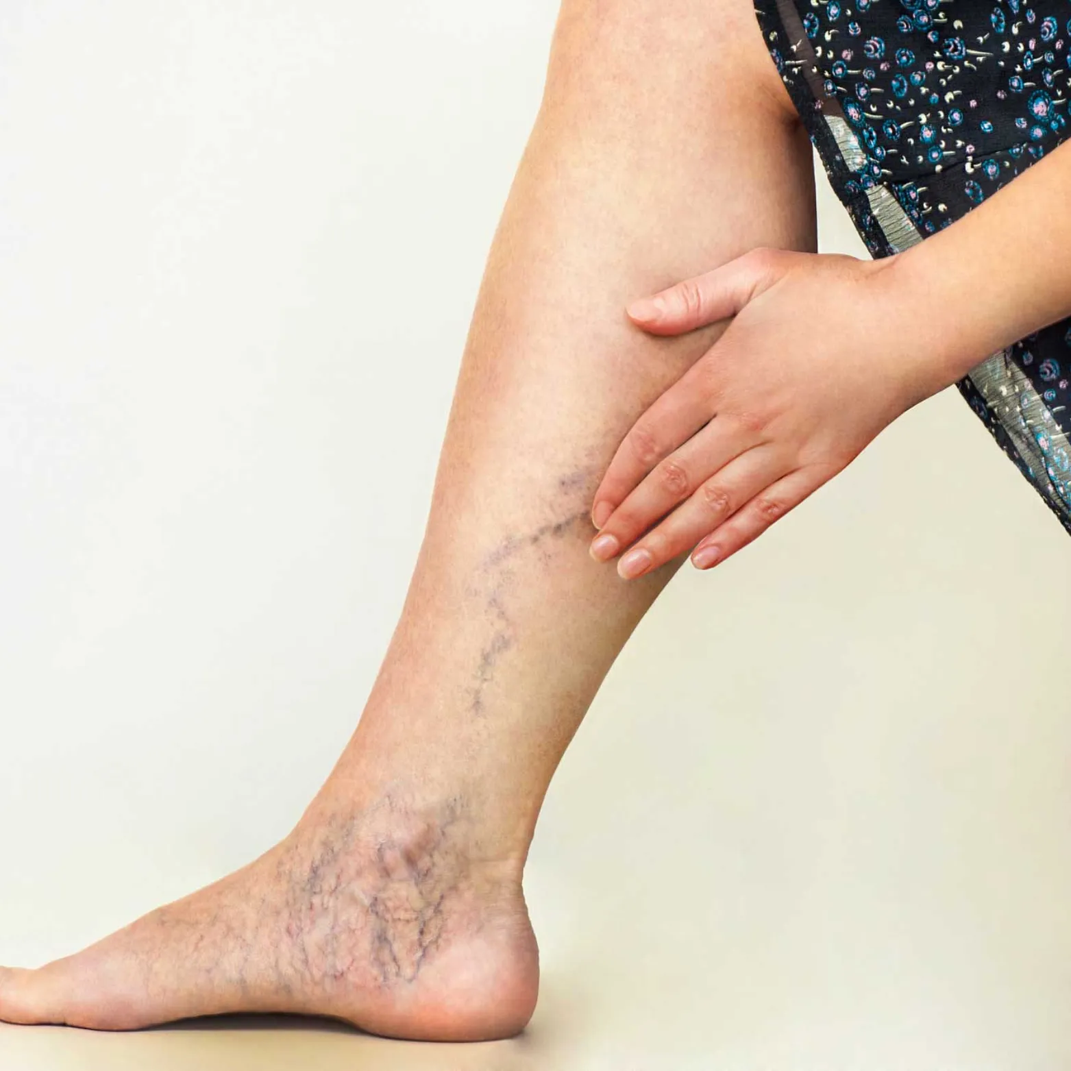 Thread Vein Removal