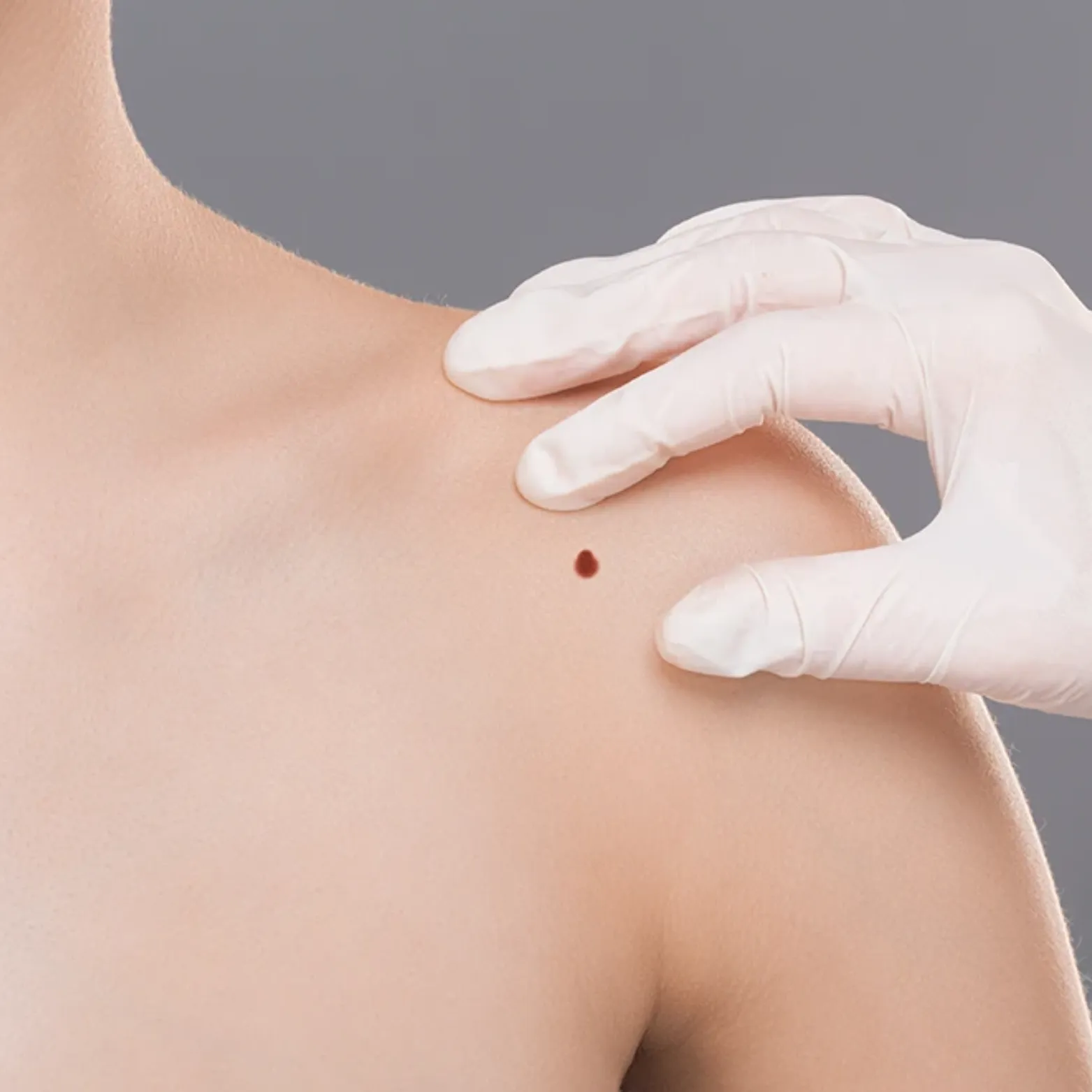 Cyst Removal