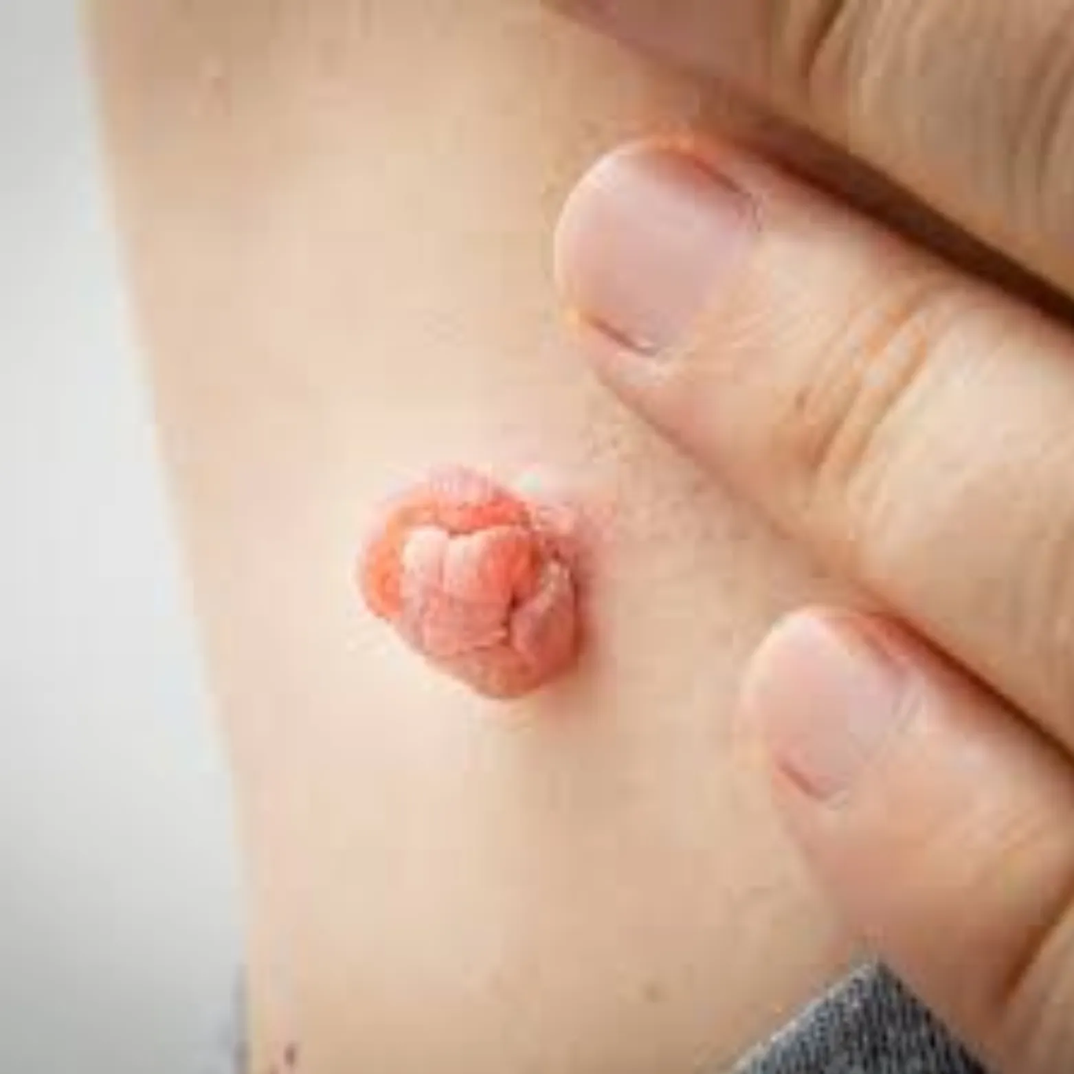 Papilloma