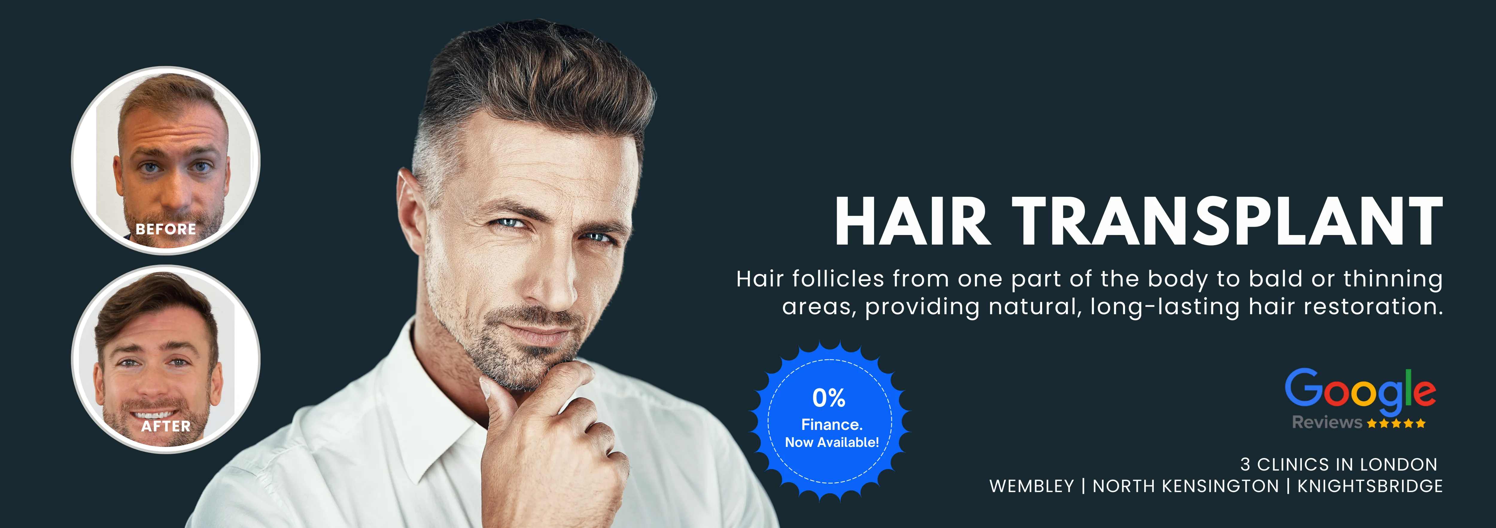 Hair Transplant