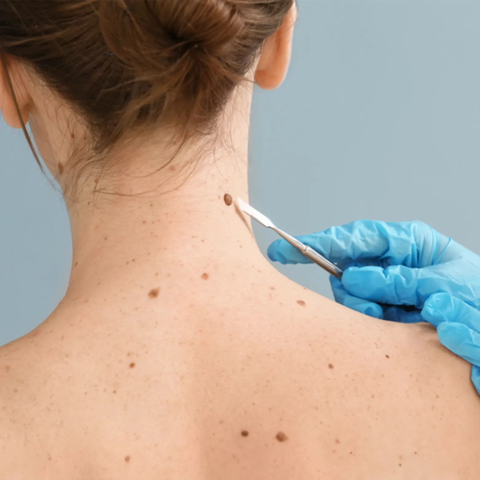 Laser Mole Removal
