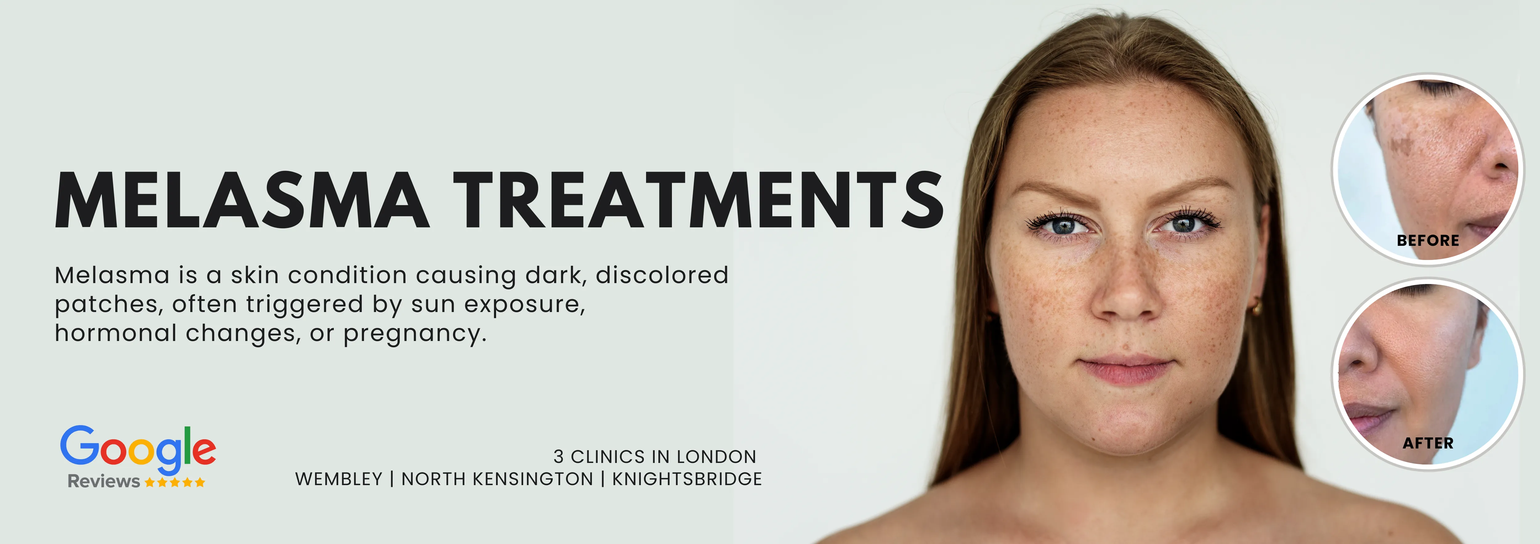 Melasma Treatment