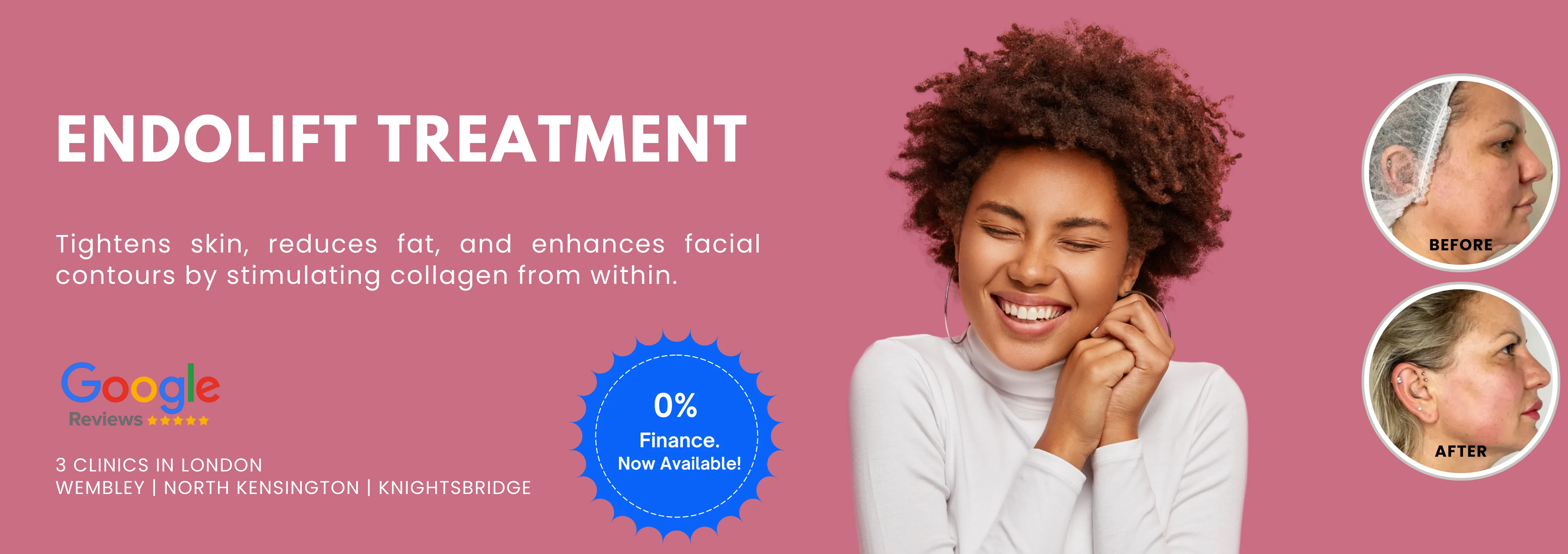 Endolift Treatment