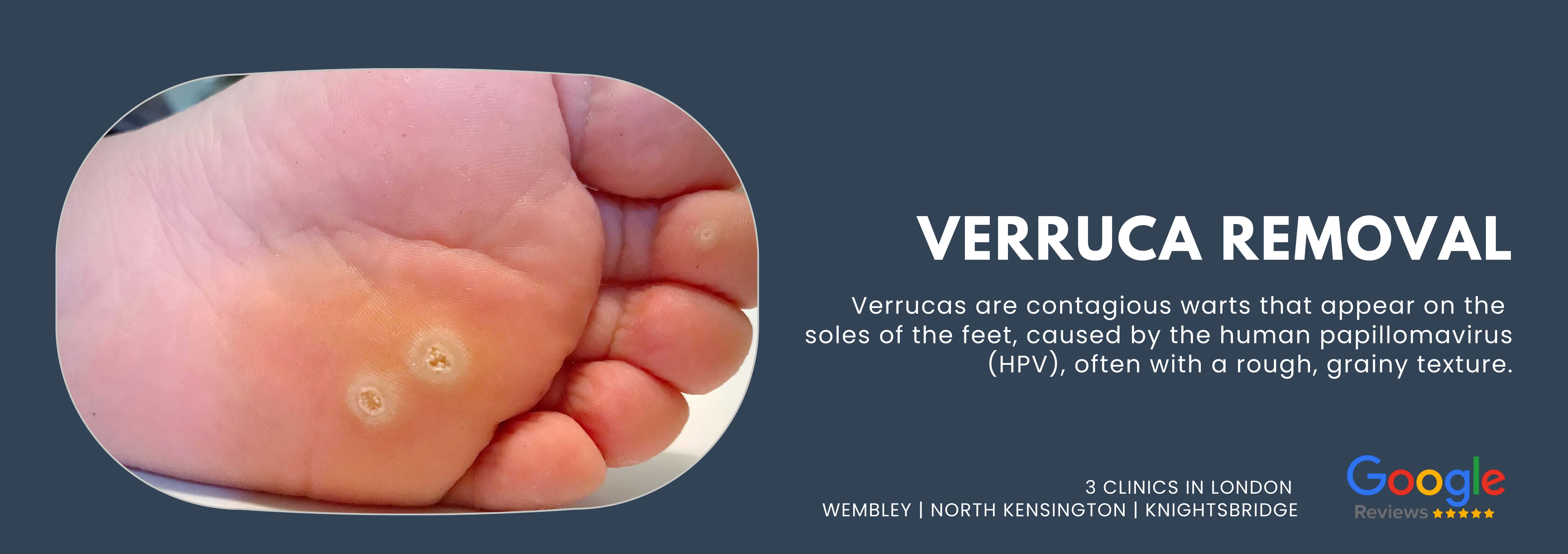 Verruca Removal