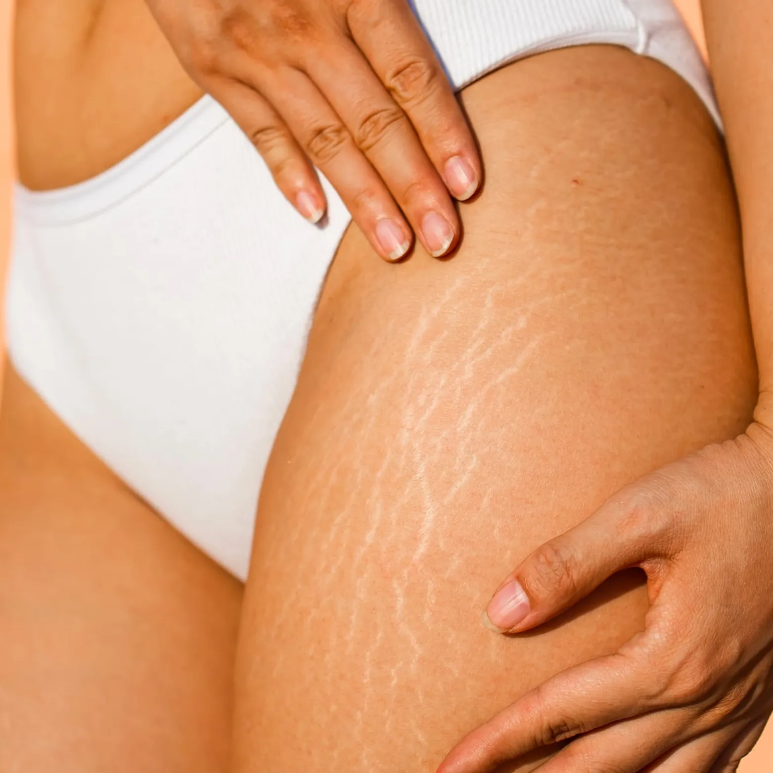 Stretch Marks